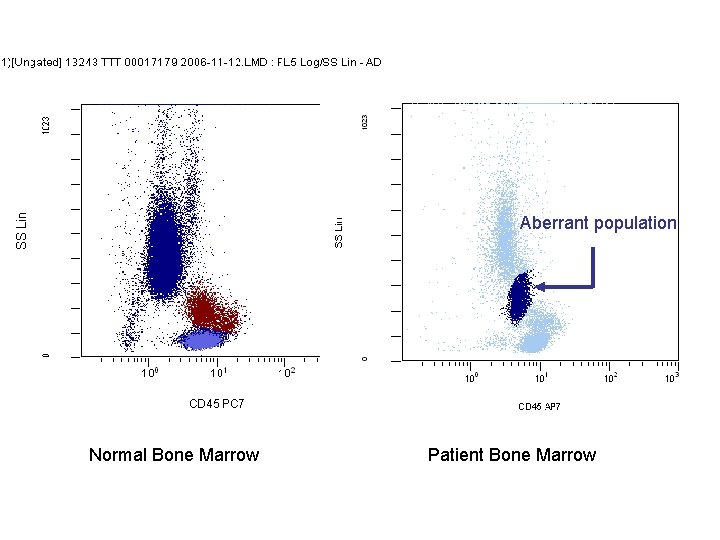 Aberrant population Normal Bone Marrow Patient Bone Marrow 