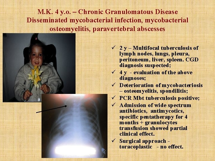 M. K. 4 y. o. – Chronic Granulomatous Disease Disseminated mycobacterial infection, mycobacterial osteomyelitis, M. K. 4 y. o. – Chronic Granulomatous Disease Disseminated mycobacterial infection, mycobacterial osteomyelitis,