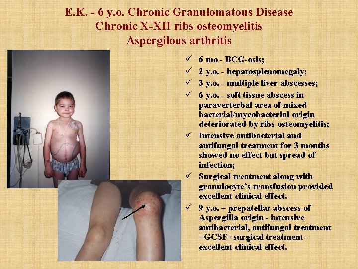 E. K. - 6 y. o. Chronic Granulomatous Disease Chronic X-XII ribs osteomyelitis Aspergilous E. K. - 6 y. o. Chronic Granulomatous Disease Chronic X-XII ribs osteomyelitis Aspergilous
