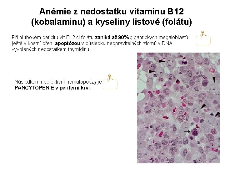 Anémie z nedostatku vitaminu B 12 (kobalaminu) a kyseliny listové (folátu) Při hlubokém deficitu