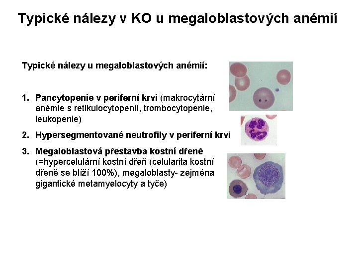 Typické nálezy v KO u megaloblastových anémií Typické nálezy u megaloblastových anémií: 1. Pancytopenie Typické nálezy v KO u megaloblastových anémií Typické nálezy u megaloblastových anémií: 1. Pancytopenie
