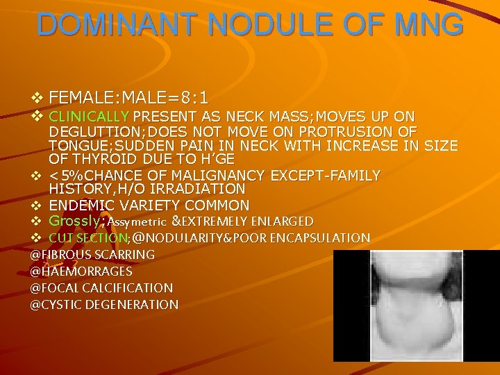 DOMINANT NODULE OF MNG v FEMALE: MALE=8: 1 v CLINICALLY PRESENT AS NECK MASS;