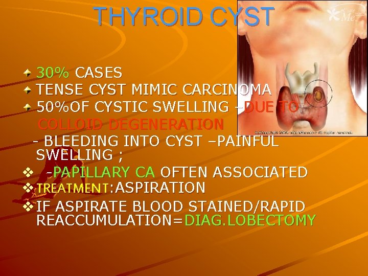 THYROID CYST 30% CASES TENSE CYST MIMIC CARCINOMA 50%OF CYSTIC SWELLING –DUE TO COLLOID