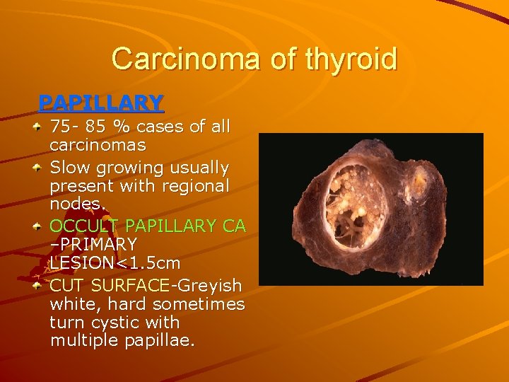 Carcinoma of thyroid PAPILLARY 75 - 85 % cases of all carcinomas Slow growing