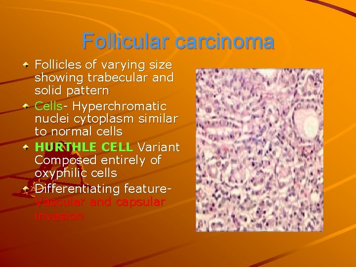 Follicular carcinoma Follicles of varying size showing trabecular and solid pattern Cells- Hyperchromatic nuclei