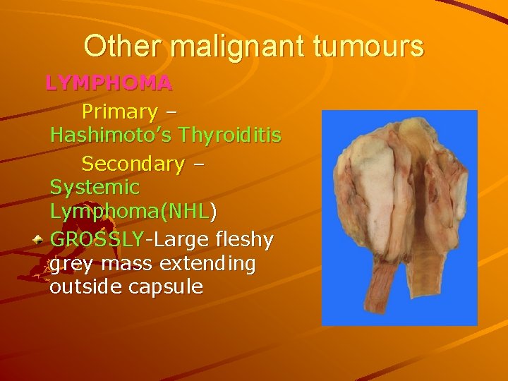 Other malignant tumours LYMPHOMA Primary – Hashimoto’s Thyroiditis Secondary – Systemic Lymphoma(NHL) GROSSLY-Large fleshy