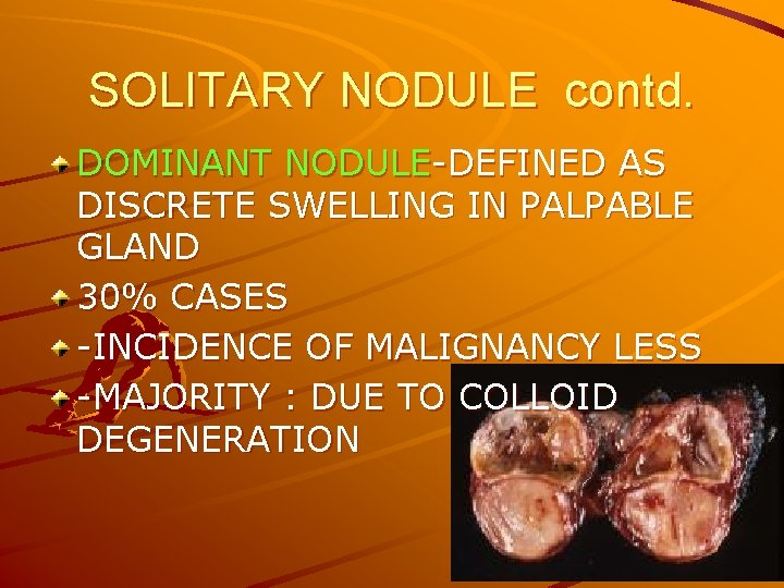 SOLITARY NODULE contd. DOMINANT NODULE-DEFINED AS DISCRETE SWELLING IN PALPABLE GLAND 30% CASES -INCIDENCE