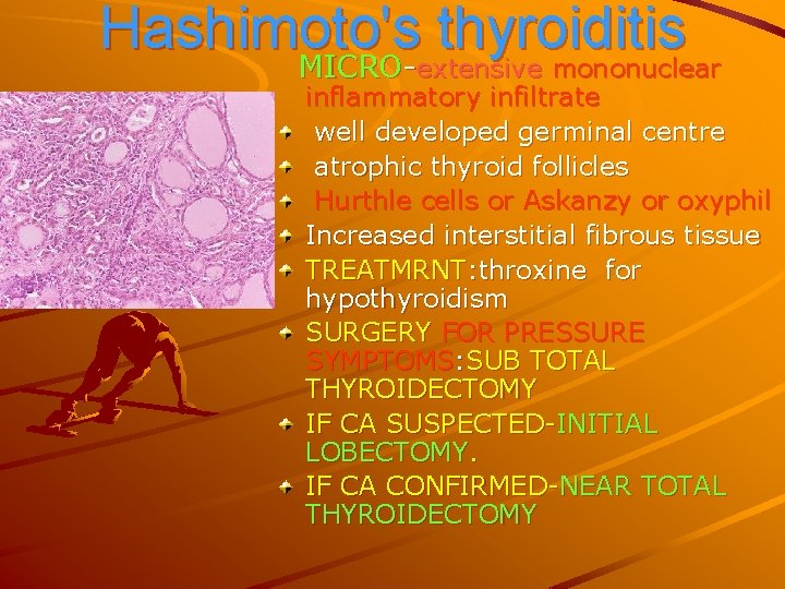 Hashimoto's thyroiditis MICRO-extensive mononuclear inflammatory infiltrate well developed germinal centre atrophic thyroid follicles Hurthle