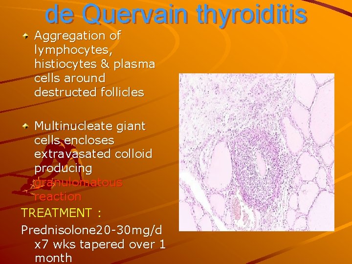 de Quervain thyroiditis Aggregation of lymphocytes, histiocytes & plasma cells around destructed follicles Multinucleate