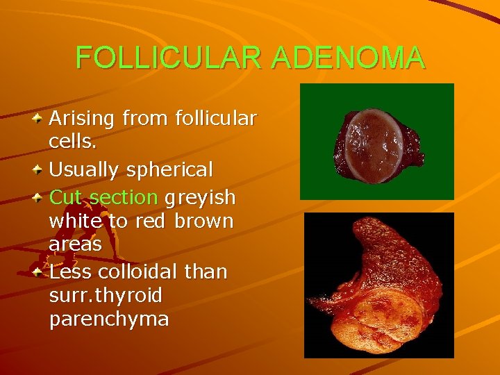 FOLLICULAR ADENOMA Arising from follicular cells. Usually spherical Cut section greyish white to red