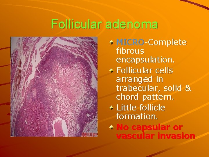 Follicular adenoma MICRO-Complete fibrous encapsulation. Follicular cells arranged in trabecular, solid & chord pattern.