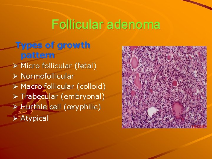 Follicular adenoma Types of growth pattern Ø Micro follicular (fetal) Ø Normofollicular Ø Macro