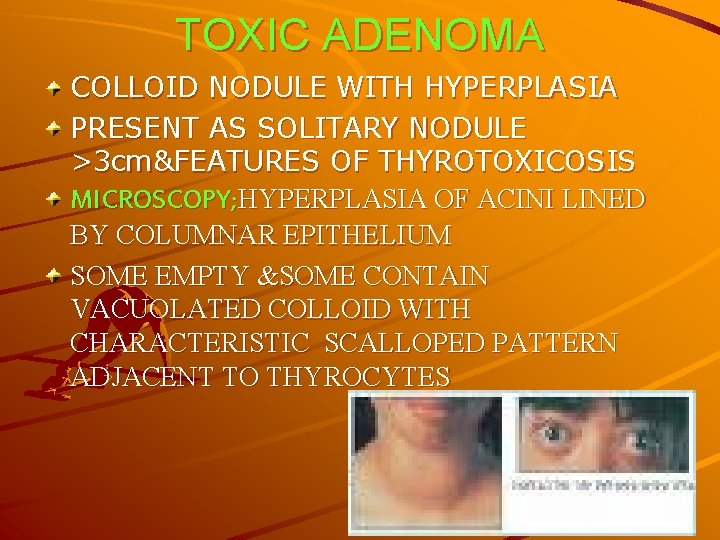 TOXIC ADENOMA COLLOID NODULE WITH HYPERPLASIA PRESENT AS SOLITARY NODULE >3 cm&FEATURES OF THYROTOXICOSIS