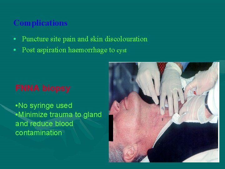 Complications • Puncture site pain and skin discolouration • Post aspiration haemorrhage to cyst