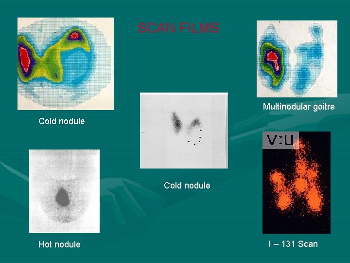 SCAN FILMS Multinodular goitre Cold nodule Hot nodule I – 131 Scan 
