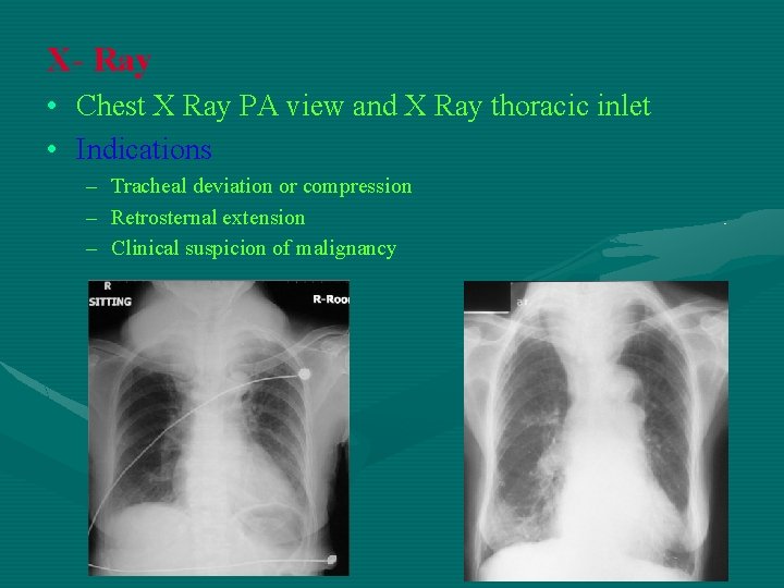 X- Ray • Chest X Ray PA view and X Ray thoracic inlet •