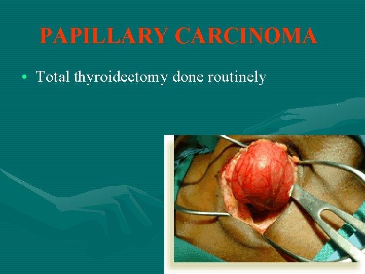 PAPILLARY CARCINOMA • Total thyroidectomy done routinely 