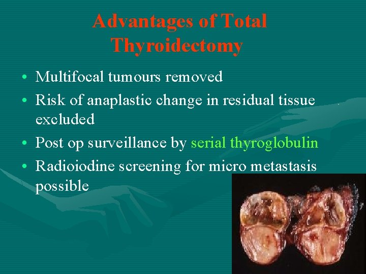 Advantages of Total Thyroidectomy • Multifocal tumours removed • Risk of anaplastic change in