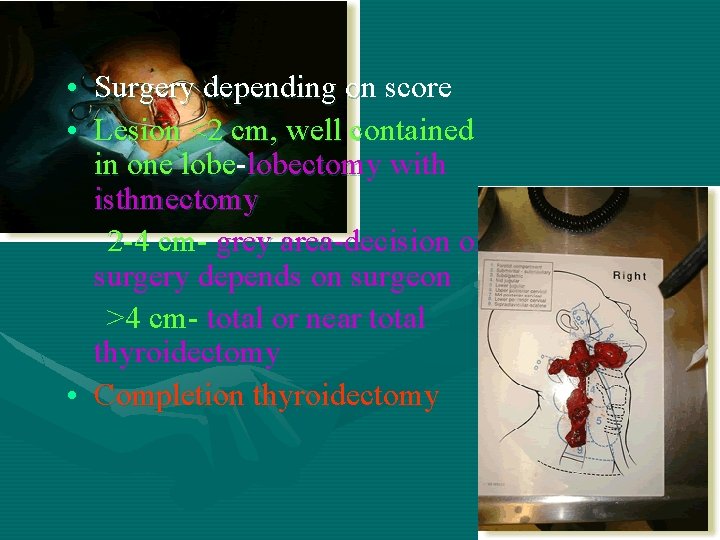 • Surgery depending on score • Lesion <2 cm, well contained in one