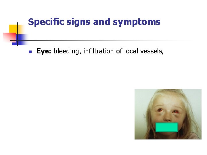 Specific signs and symptoms n Eye: bleeding, infiltration of local vessels, 