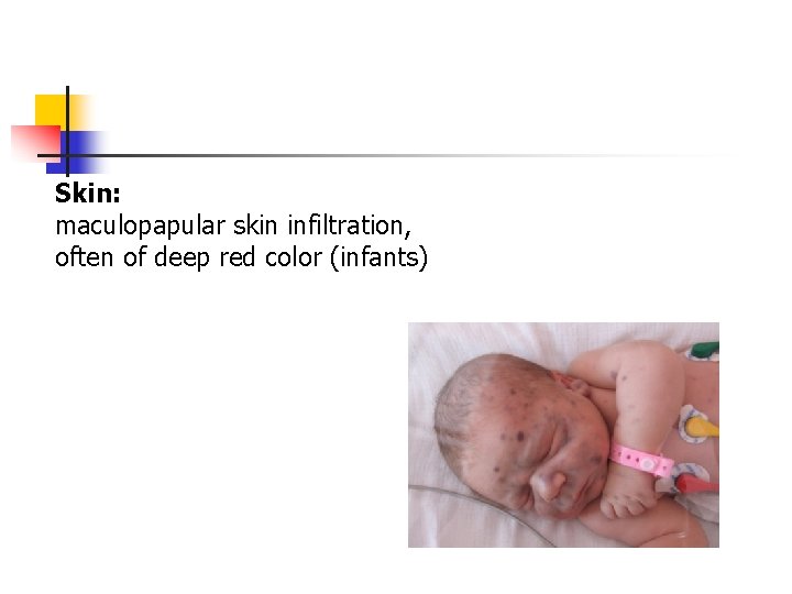 Skin: maculopapular skin infiltration, often of deep red color (infants) 