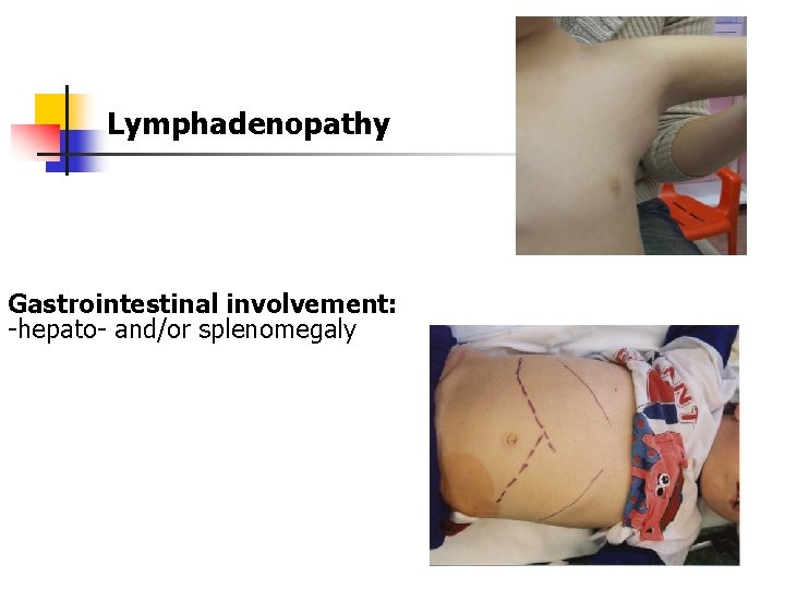 Lymphadenopathy Gastrointestinal involvement: -hepato- and/or splenomegaly 