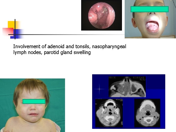 Involvement of adenoid and tonsils, nasopharyngeal lymph nodes, parotid gland swelling 