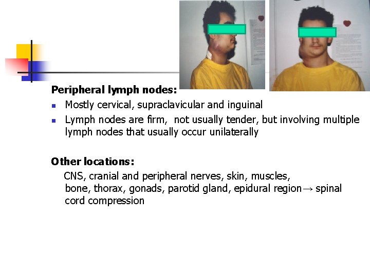 Peripheral lymph nodes: n Mostly cervical, supraclavicular and inguinal n Lymph nodes are firm,