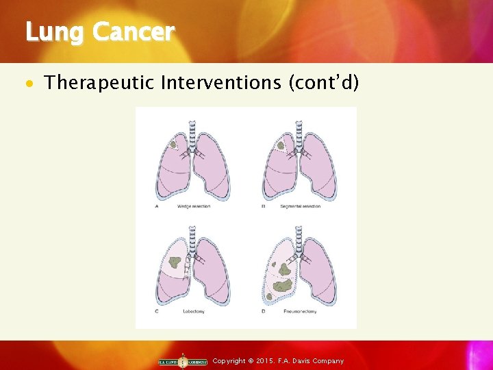 Lung Cancer · Therapeutic Interventions (cont’d) Copyright © 2015. F. A. Davis Company 
