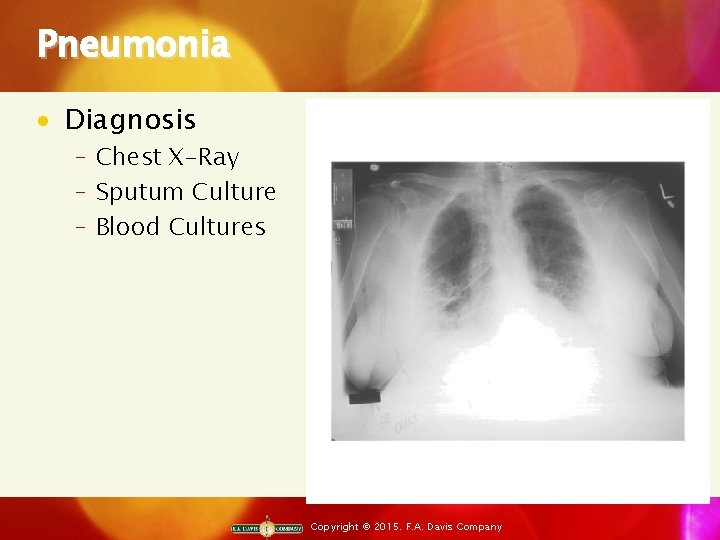 Pneumonia · Diagnosis ‒ Chest X-Ray ‒ Sputum Culture ‒ Blood Cultures Copyright ©