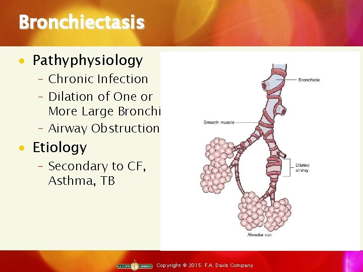 Bronchiectasis · Pathyphysiology ‒ Chronic Infection ‒ Dilation of One or More Large Bronchi