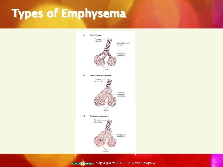 Types of Emphysema Copyright © 2015. F. A. Davis Company 