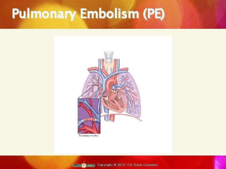 Pulmonary Embolism (PE) Copyright © 2015. F. A. Davis Company 