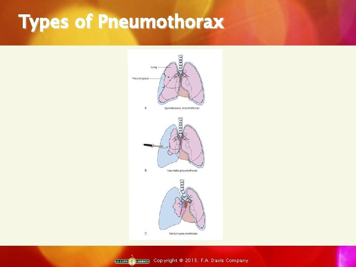 Types of Pneumothorax Copyright © 2015. F. A. Davis Company 