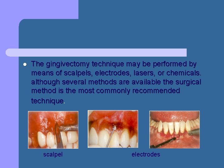 l The gingivectomy technique may be performed by means of scalpels, electrodes, lasers, or l The gingivectomy technique may be performed by means of scalpels, electrodes, lasers, or