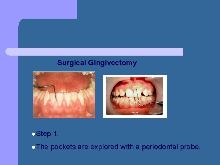 Surgical Gingivectomy l. Step l. The 1. pockets are explored with a periodontal probe. Surgical Gingivectomy l. Step l. The 1. pockets are explored with a periodontal probe.