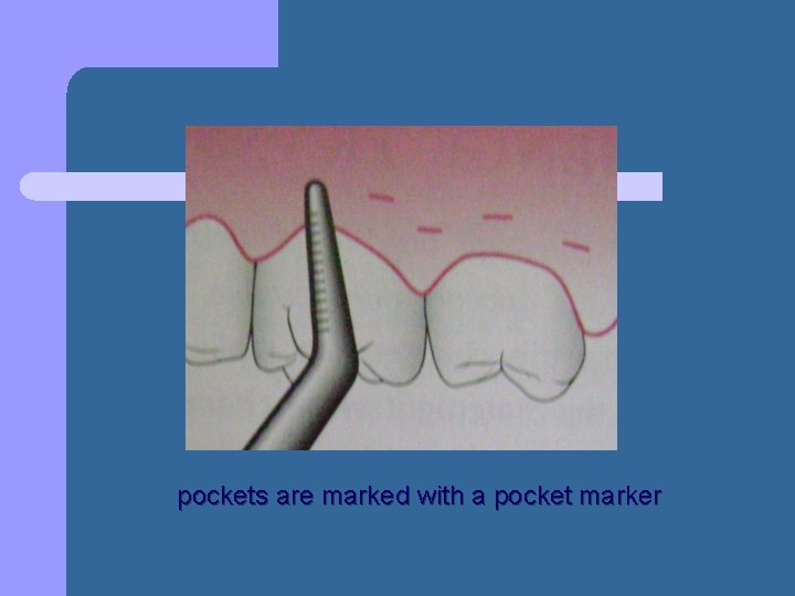 pockets are marked with a pocket marker pockets are marked with a pocket marker