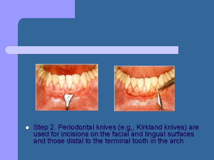 l Step 2. Periodontal knives (e. g, , Kirkland knives) are used for incisions l Step 2. Periodontal knives (e. g, , Kirkland knives) are used for incisions