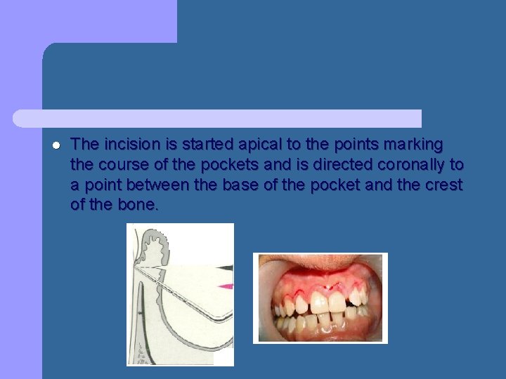 l The incision is started apical to the points marking the course of the l The incision is started apical to the points marking the course of the