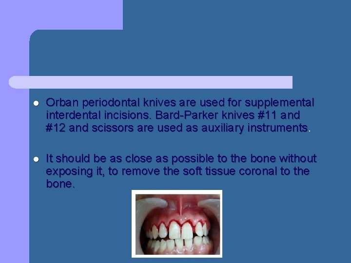 l Orban periodontal knives are used for supplemental interdental incisions. Bard-Parker knives #11 and l Orban periodontal knives are used for supplemental interdental incisions. Bard-Parker knives #11 and