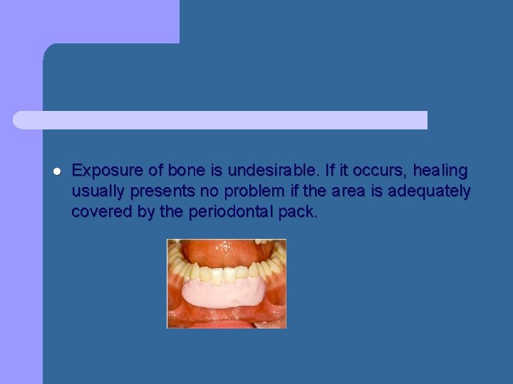 l Exposure of bone is undesirable. If it occurs, healing usually presents no problem l Exposure of bone is undesirable. If it occurs, healing usually presents no problem