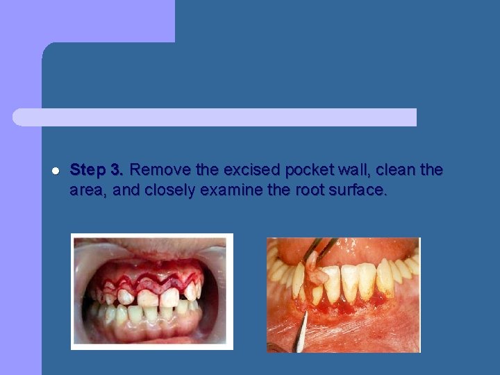 l Step 3. Remove the excised pocket wall, clean the area, and closely examine l Step 3. Remove the excised pocket wall, clean the area, and closely examine