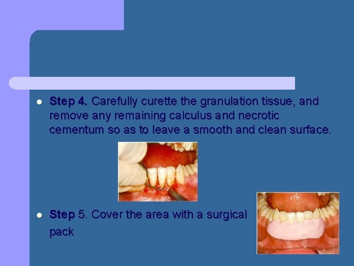 l Step 4. Carefully curette the granulation tissue, and remove any remaining calculus and l Step 4. Carefully curette the granulation tissue, and remove any remaining calculus and