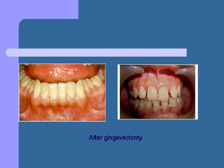 After gingevectomy After gingevectomy