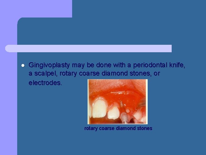 l Gingivoplasty may be done with a periodontal knife, a scalpel, rotary coarse diamond l Gingivoplasty may be done with a periodontal knife, a scalpel, rotary coarse diamond