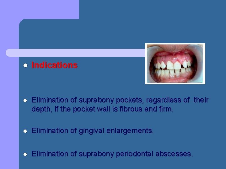 l Indications l Elimination of suprabony pockets, regardless of their depth, if the pocket l Indications l Elimination of suprabony pockets, regardless of their depth, if the pocket