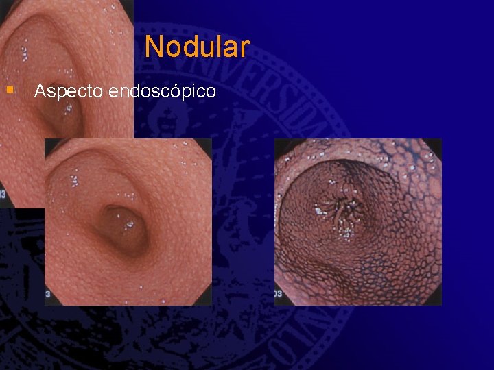 Gastrite Nodular § Aspecto endoscópico Gastrite Nodular § Aspecto endoscópico