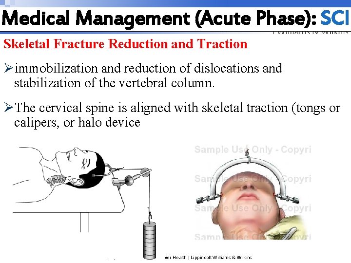 Medical Management (Acute Phase): SCI Skeletal Fracture Reduction and Traction Øimmobilization and reduction of Medical Management (Acute Phase): SCI Skeletal Fracture Reduction and Traction Øimmobilization and reduction of