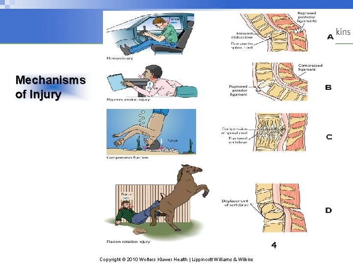 Mechanisms of Injury 4 Copyright © 2010 Wolters Kluwer Health | Lippincott Williams & Mechanisms of Injury 4 Copyright © 2010 Wolters Kluwer Health | Lippincott Williams &
