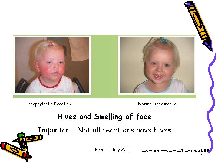 Anaphylactic Reaction Normal appearance Hives and Swelling of face Important: Not all reactions have